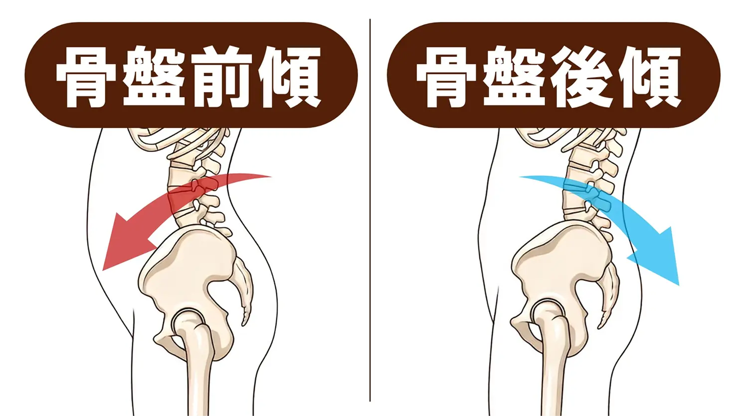骨盤の傾きの比較。ただ左右差は誰にでも多少あり、ゆがみ=不調