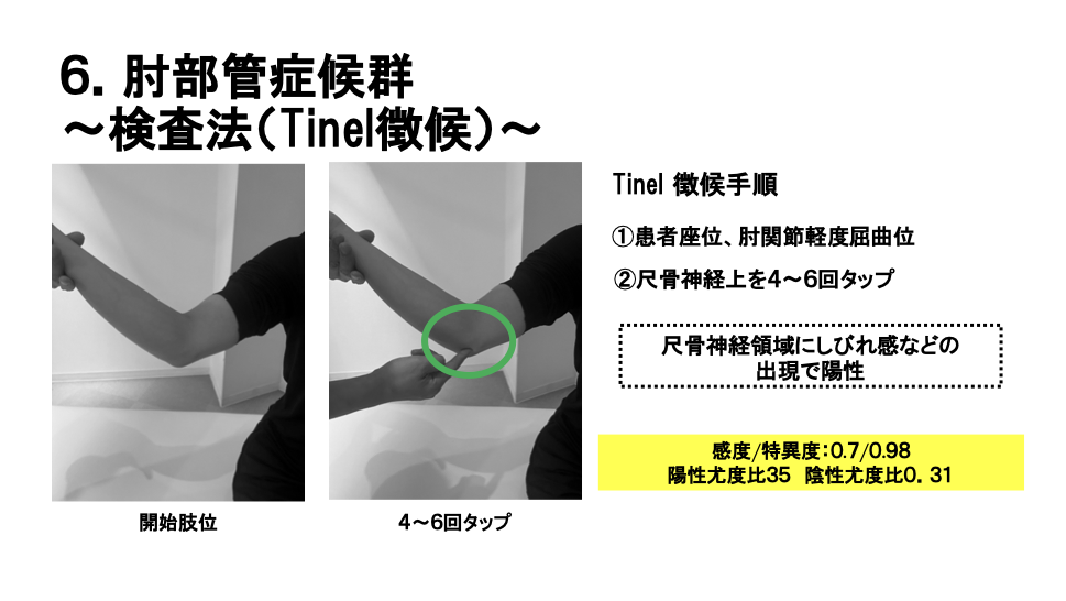 肘部管症候群の尺骨神経チネル徴候