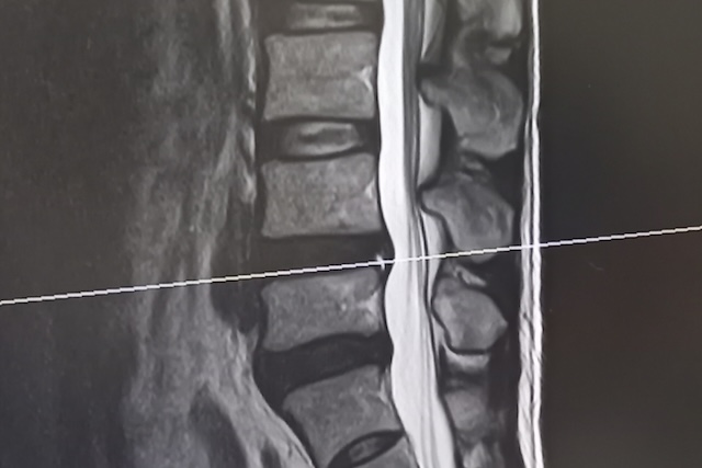 腰椎のMRI(エムアールアイ)画像のイメージ