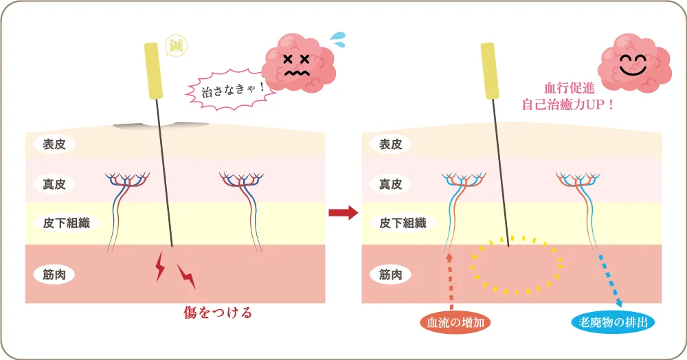 鍼灸の仕組みの図解。鍼の小さな刺激に身体が反応して血流が集まり、老廃物の排出が促される