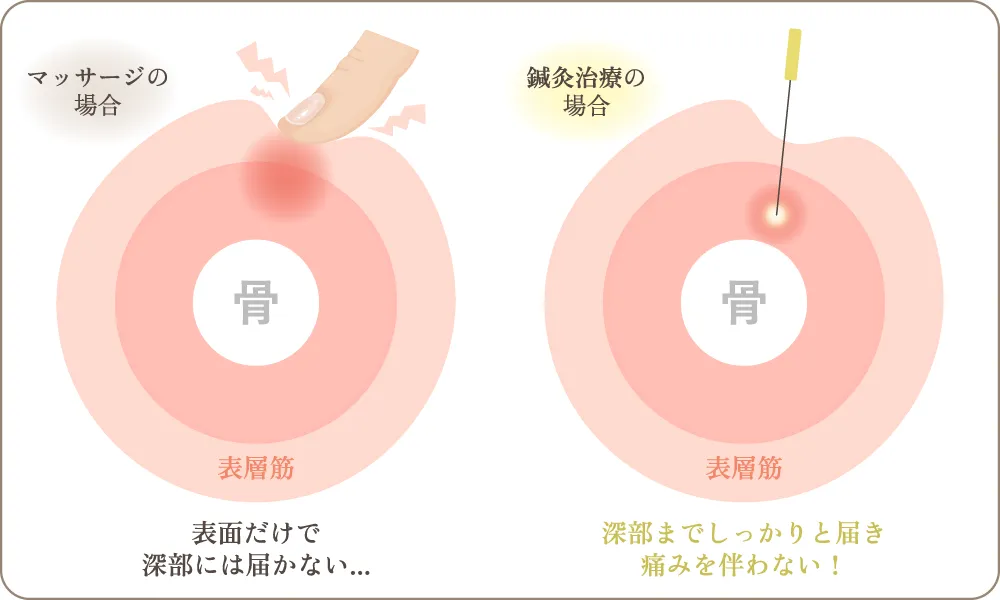 マッサージと鍼灸の違いの図解。指の圧は表層の筋肉まで、鍼は深部の筋肉まで直接届く